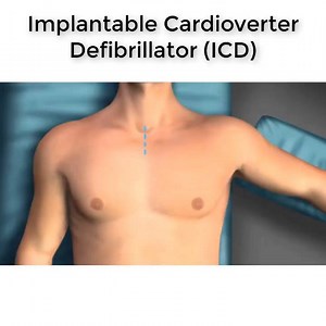 Implantable Cardioverter Defibrillator(ICD) | Help You