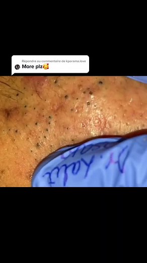 extraction points noirs video