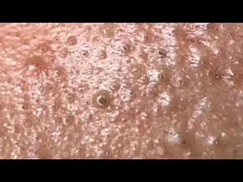 Extraction profonde des points noirs Acné kystique et popping #11