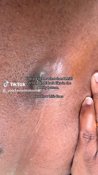 Understanding PASH Syndrome: Awareness and Insights