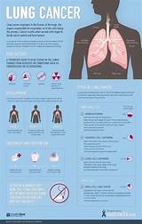 Pictures of Can You Cure Small Cell Lung Cancer