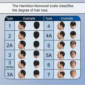 Hamilton Norwood Scale Measure Hair Loss With Hamilton Norwood