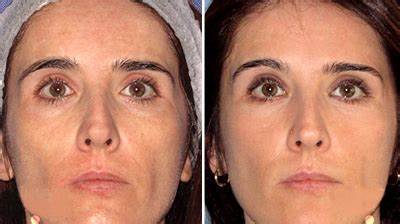 FOTONA 4D® LASER for Non Invasive Face Lifting & Skin Tightening, Smoothing Out Imperfections ...