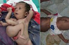 baby twin parasitic born limbs removed foxnews has twins extra parasite after old before her attached