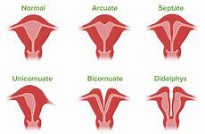 malformations uterus congenital reproductive anomalies cervix ipsilateral renal skeletal typically cua abdominal