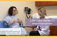 lactation breast engorgement