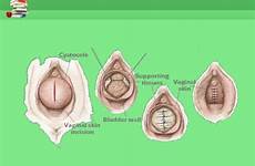 prolapse uterine