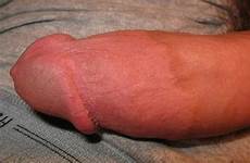 circumcised intact vs disturbing penis frenulum sensitive most lrg observation ejaculations without missing looks
