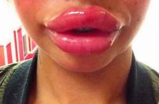 lips giant squiggly big fillers thesun pout bigger mum fad hope latest know after ever look ones didn goodyfeed