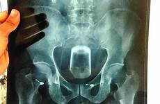 glass beer constipation stuck man shoved his getting into people inserts butt rectum inserting ray rear bottom why daily has