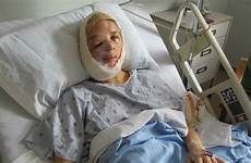 girl face teen facial half rare sarah deformity after atwell