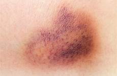 hematoma ablation cardiac causes bruise