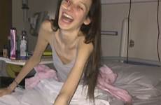 anorexic anorexia teen teenager chloe dublin disappear wanted wasn