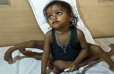deformities oddities limbs conjoined lakshmi parasite conditions chilango