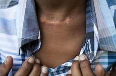 boy his throat attack shows scar hope cnn operation 2010 miracle recovery brutal horror me