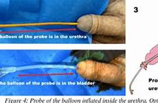 urethral tricks catheterization
