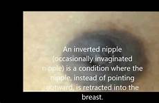 inverted nipples