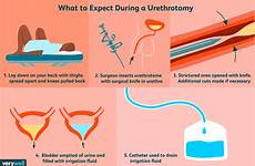 procedure urethra drain pipe