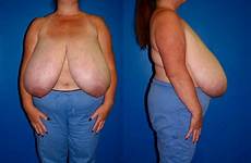 reduction breast saggy udders