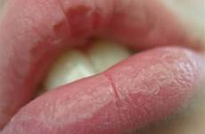 lips chapped dry heal homemade therapy swollen cracked lip diy cure labios remedies moisture picking skin ehec healthy avoid beauty