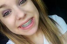 braces girls cute tumblr colors smile teeth brace wet green dental face discover bands