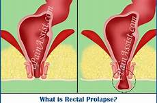 prolapse rectal anus anal pain protrusion male surgery causes pelvic exercise experience inside treatment symptoms just women men hemorrhoids exercises