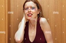 face scared bruises woman abused visible alamy young