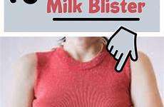 milk blister breastfeeding pumping remedies blisters blebs