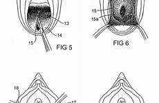 repair patents vagina drawing pelvic organ damaged