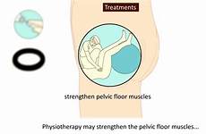 prolapse causes treatment