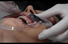 dentist retractor mouth retainer permanent upper fetish start