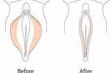 labia labial hypertrophy labiaplasty treatments enlarged