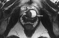 urethra urethral diverticulum radiographics
