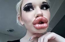 lips biggest lip injections fillers pouty andrea viral goes getting after woman via instagram ivanova