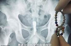 man inserted urethra stuck inserts dreaming bladder bundled insertion
