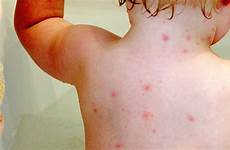 pox mild chickenpox macam journeyboost gatal penyakit kulit contracting herbal obat