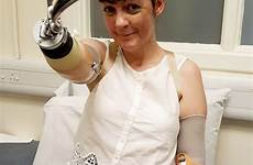hooks amputee amputated prosthetic dbe elbow stump left organ limbless prosthetics kathleen collapses wakes carer metro