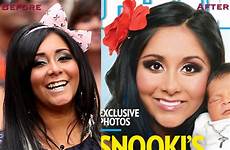 before after snooki surgery plastic breast veneers teeth celebrity nose implants boob job dentures fake she jobs dental actors
