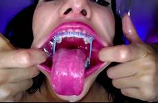 braces tongue fishhook