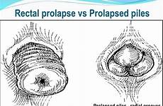 rectal prolapse prolapsed piles radial concentric grooves laparoscopic