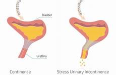 incontinence coital urinary sexual urine ejaculation vibrance leaking intercourse