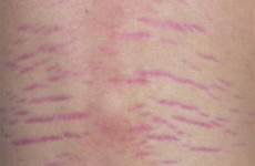 marks stretch causes stretchmarks red mark treatments prevention explained striae scars after do between there if where november posted middle