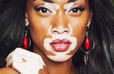 vitiligo winnie harlow pale pigment chantelle who