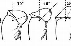 frenulum breve male foreskin tight phimosis do gif erection