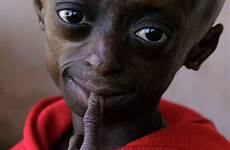 progeria bolezni ageing premature