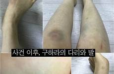 hara abuse idols koo injuries gets assault bruises kara nextshark