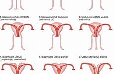 genital female development abnormal tract anomalies classification malformation surgery fig