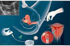 insemination intrauterine iui treatment fertility artificial pregnancy women ivf injection fertilization sperm expert sections our bloglovin article