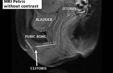 clitoral clitoris mri function pelvic woes yahoo glans