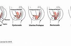 prolapse pelvic uterine recti diastasis dysfunction urinary